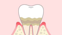 歯周病専門医 ハマダデンタルクリニック 歯周病治療